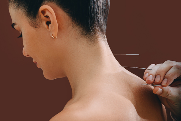 Acupuncture